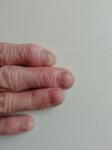 Грибок ногтя у пожилого человека фото 1