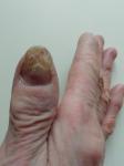 Грибок ногтя у пожилого человека фото 2