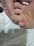 Мозоль на пальце ноги фото 1