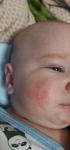 Сыпь на лице в виде покраснения и стянутости месячного ребёнка фото 1
