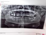 Боли оба ряда зубов пульпит тройничный нерв панорамный снимок комментарии фото 1