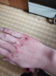 Раздражение и шелушение кожи рук фото 1