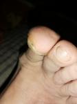Подногтевая меланома, полоска на ногте большого пальца фото 3