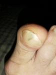 Подногтевая меланома, полоска на ногте большого пальца фото 2