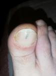 Подногтевая меланома, полоска на ногте большого пальца фото 1