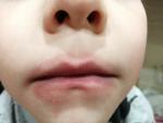 Красная кайма вокруг рта у ребёнка фото 1