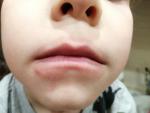 Красная кайма вокруг рта у ребёнка фото 2