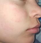 Красные пятна на щеках у ребенка фото 1