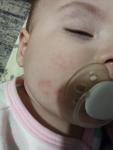 Шершавая сыпь на лице и теле ребенка фото 1