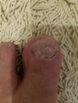 Дырки на ногте большого пальца ноги фото 1