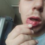 Рассечение губы, как скоро заживет? фото 1