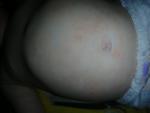 Сыпь у ребенка 11 месяцев фото 2