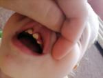 Покраснели десна и пожелтели зубы у ребёнка фото 1