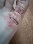 Трещины на пальцах ног фото 2