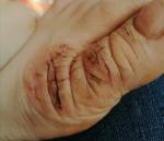 Трещины на пальцах ног фото 1