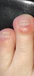 Воспаление на пальце ноги фото 2