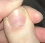 Пятно на ногте после травмирования фото 1