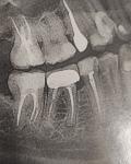 Кисты на корнях зуба фото 1
