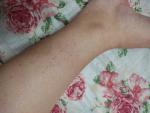 Сыпь красные точки по всей длине ноги фото 2