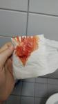 Кровит после биопсии радиоволной фото 2