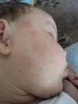 Высыпания на лице у младенца фото 2