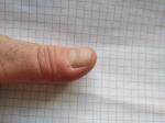 Болит палец около ногтя фото 3