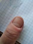 Болит палец около ногтя фото 1