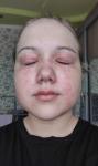 Аллергия на лице, вокруг глаз в виде красных пятен фото 1