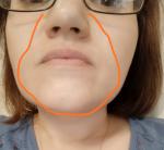 Себорейный дерматит носогубного треугольника и розецеа лица фото 3