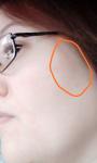 Себорейный дерматит носогубного треугольника и розецеа лица фото 2
