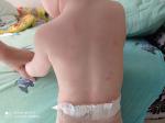 Высыпания на спине и животе у ребёнка фото 2