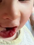 Стоматит или герпес на губе у ребёнка? фото 2
