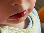 Стоматит или герпес на губе у ребёнка? фото 1