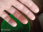 Трещины рук прыщики с жидкостью зуд деформация ногтя фото 4