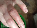 Трещины рук прыщики с жидкостью зуд деформация ногтя фото 3