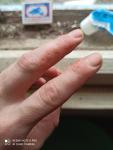 Трещины рук прыщики с жидкостью зуд деформация ногтя фото 2