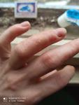 Трещины рук прыщики с жидкостью зуд деформация ногтя фото 1