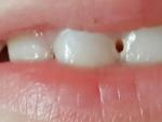 Кариес зубов фото 1