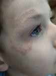 Высыпания у ребёнка на лице. Больше месяца не проходит фото 2