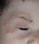 Высыпания у ребёнка на лице. Больше месяца не проходит фото 1