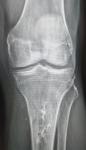 Нога, снимок, большеберцовая кость фото 1