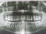Панорамный снимок зубов фото 1