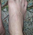 Сыпь на стопах ног фото 3
