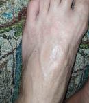 Сыпь на стопах ног фото 2