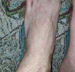 Сыпь на стопах ног фото 1
