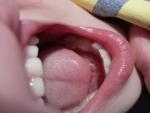 Пятна на зубах фото 3