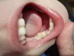 Пятна на зубах фото 2