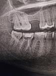 Перфорация корня зуба фото 1