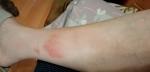 Красное болезненное пятно на ноге с отеком щиколотки фото 2