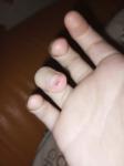 Болячка на пальце, черн-красная, болит, появилось сегодня фото 1